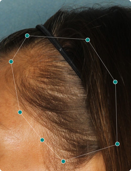 A close-up of the side of a woman's head with brunette hair before using Nutrafol, showing visible hair thinning at the scalp and hairline.
